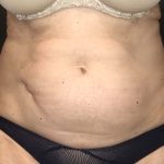 Liposuction Before & After Patient #11632