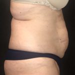 Liposuction Before & After Patient #11632