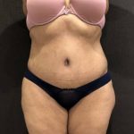 Tummy Tuck Before & After Patient #11648