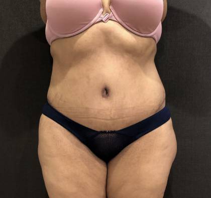 Tummy Tuck Before & After Patient #11648