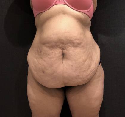 Tummy Tuck Before & After Patient #11648