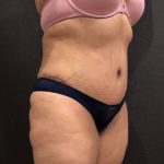 Tummy Tuck Before & After Patient #11648