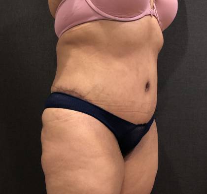 Tummy Tuck Before & After Patient #11648