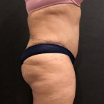 Tummy Tuck Before & After Patient #11648