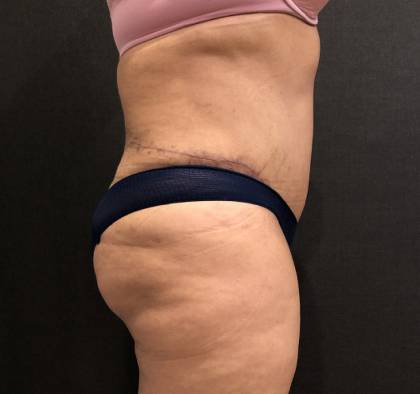 Tummy Tuck Before & After Patient #11648