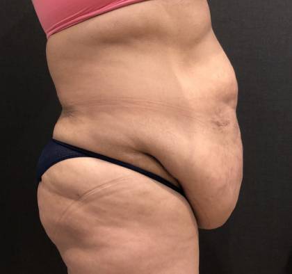 Tummy Tuck Before & After Patient #11648