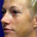 Laser Skin Resurfacing Before & After Patient #12024