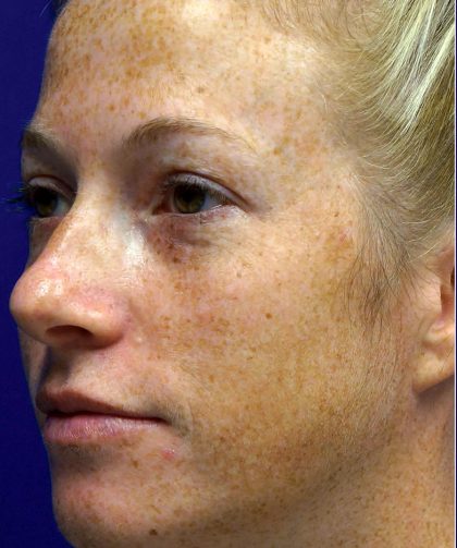 Laser Skin Resurfacing Before & After Patient #12024