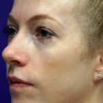 Laser Skin Resurfacing Before & After Patient #12024