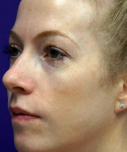 Laser Skin Resurfacing Before & After Patient #12024