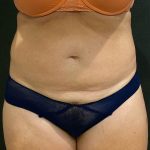 Liposuction Before & After Patient #12125