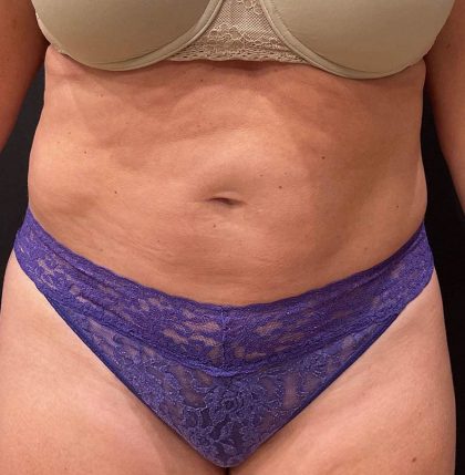 Liposuction Before & After Patient #12125