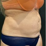 Liposuction Before & After Patient #12125
