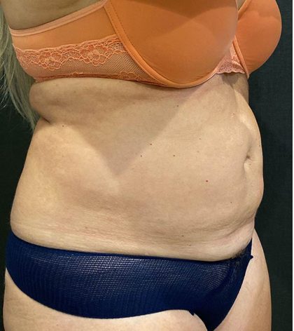 Liposuction Before & After Patient #12125