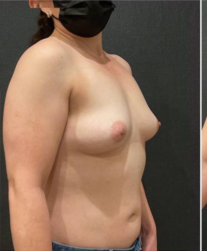 Breast Augmentation Before & After Patient #12062