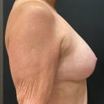 Breast Reduction Before & After Patient #12050