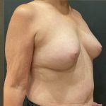 Breast Reduction Before & After Patient #12050