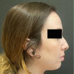 Rhinoplasty Before & After Patient #12055