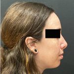 Rhinoplasty Before & After Patient #12055