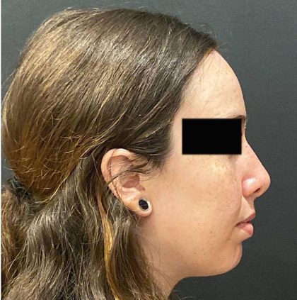 Rhinoplasty Before & After Patient #12055