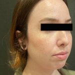 Rhinoplasty Before & After Patient #12055