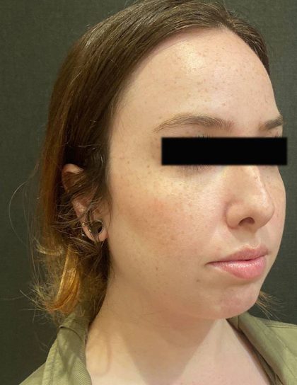 Rhinoplasty Before & After Patient #12055