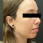 Rhinoplasty Before & After Patient #12055