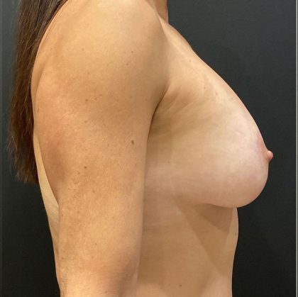 Breast Implants Revision Before & After Patient #12112