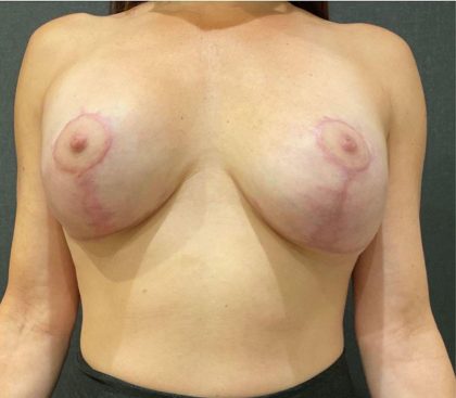 Breast Implants Revision Before & After Patient #12112