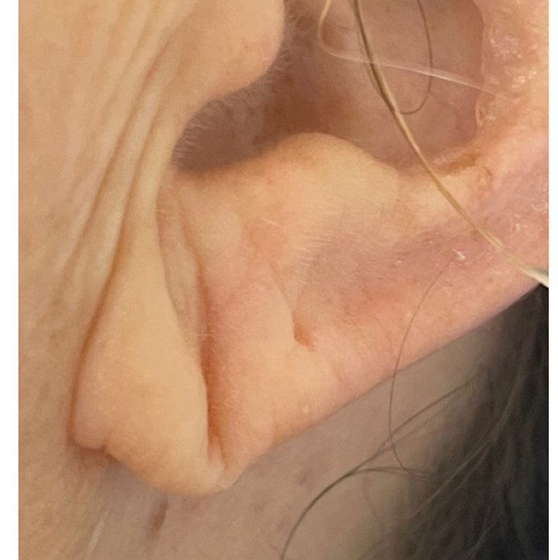 Injectables Before & After Patient #12135