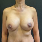 Breast Implants Revision Before & After Patient #12189