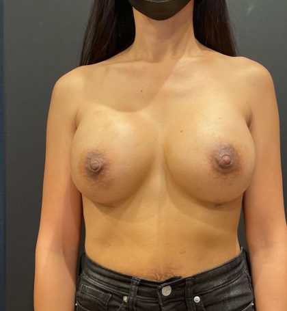 Breast Implants Revision Before & After Patient #12189