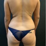 Fat Transfer to Butt Before & After Patient #12094