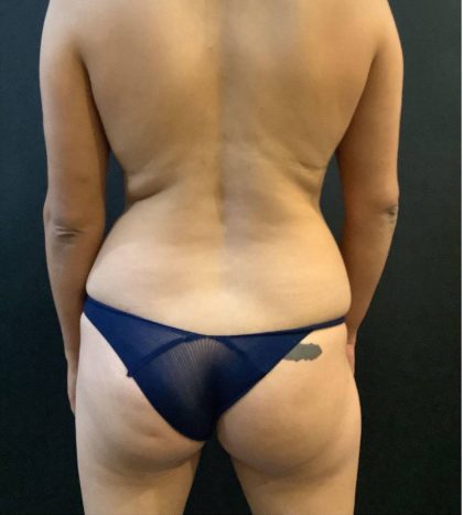 Fat Transfer to Butt Before & After Patient #12094