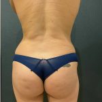 Fat Transfer to Butt Before & After Patient #12094