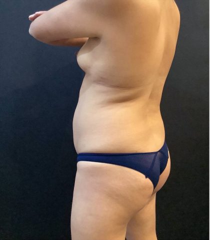 Fat Transfer to Butt Before & After Patient #12094