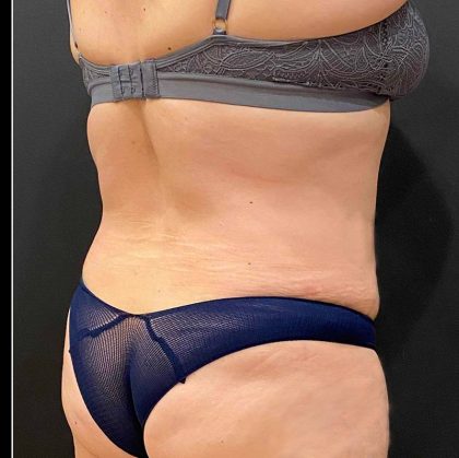 Liposuction Before & After Patient #12076