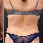 Liposuction Before & After Patient #12076