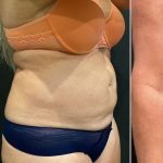 Liposuction Before & After Patient #12148