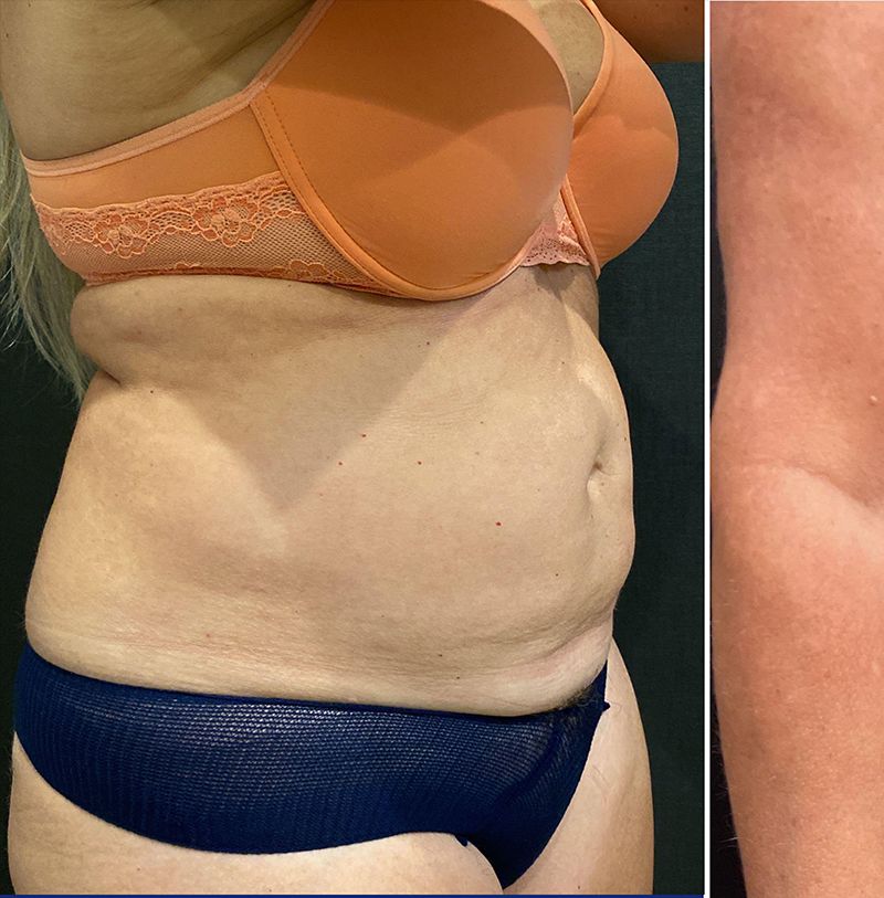 Liposuction Before & After Patient #12148