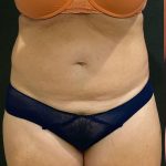 Liposuction Before & After Patient #12148