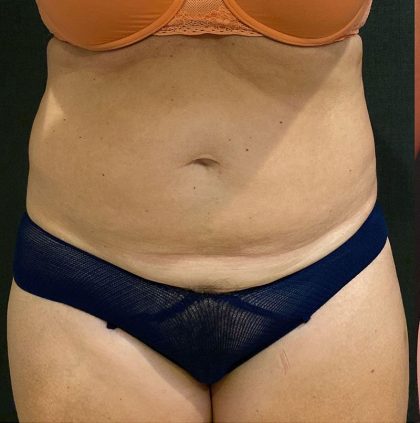 Liposuction Before & After Patient #12148