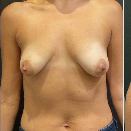 Breast Augmentation Before & After Patient #12105