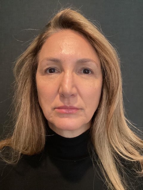 Injectables Before & After Patient #12070