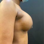 Breast Implants Revision Before & After Patient #12197