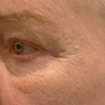 Eyelid Surgery Before & After Patient #12246