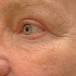 Eyelid Surgery Before & After Patient #12246