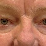 Eyelid Surgery Before & After Patient #12246