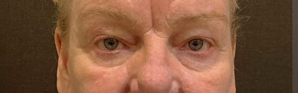 Eyelid Surgery Before & After Patient #12246