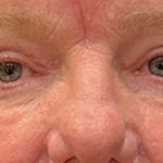 Eyelid Surgery Before & After Patient #12246